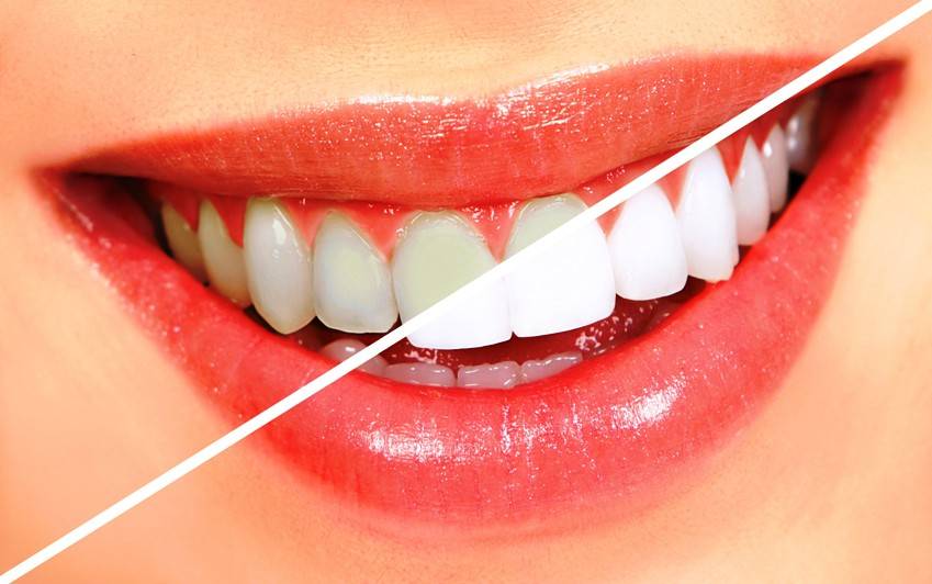 Ας δούμε πώς θα αποφύγετε τις δυσχρωμίες, αποκτώντας λαμπερή οδοντοστοιχία.
