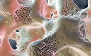 Οστεοπενία: Η Κατάλληλη Θεραπεία