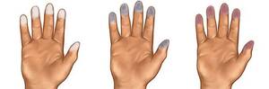 Σύνδρομο Raynaud: Κρύα Χέρια, Πόδια, Μύτη, Αυτιά