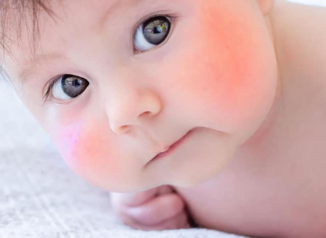 Τώρα, με την είσοδο του χειμώνα, εμφανίζονται συχνά κοκκινίλες γύρω από το στόμα του μωρού σας και ίσως βλέπετε ότι αυτό επιδεινώνεται.