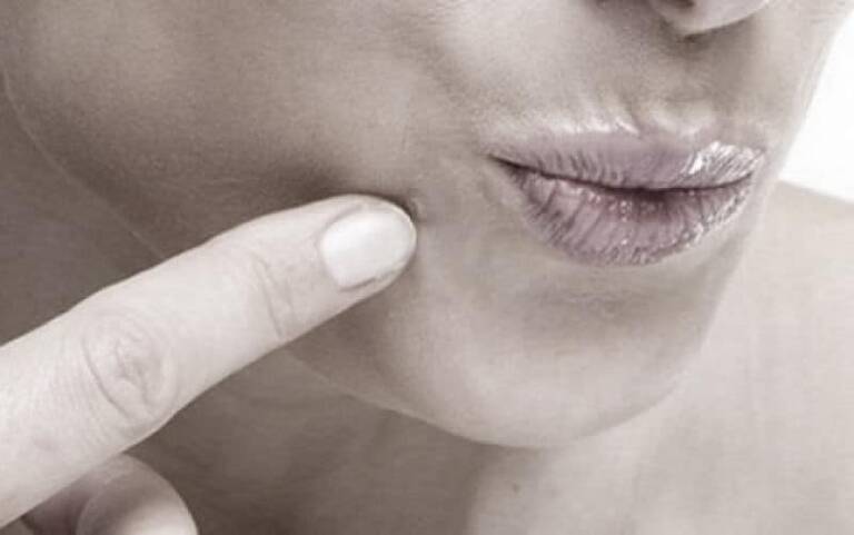 Αποτελεσματικοί Τρόποι για να Θεραπεύσετε τις Μυρμηγκιές