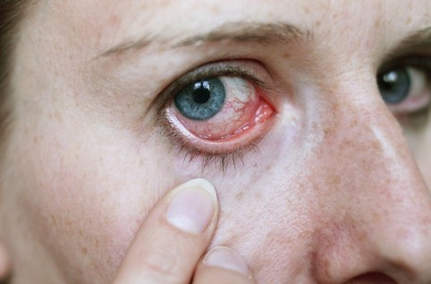 Η επιπεφυκίτιδα είναι μία από τις πιο συχνές παθήσεις των οφθαλμών.