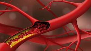 Κατά Πόσο η Χαμηλή Κακή Χοληστερίνη Μειώνει τον Καρδιαγγειακό Κίνδυνο;