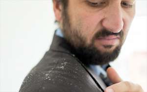 5 Τρόποι για να Εξαφανίσεις την Πιτυρίδα