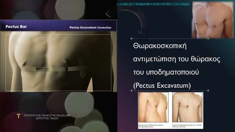 Θωρακοσκοπική Αντιμετώπιση του Θώρακος του Υποδηματοποιού (Pectus Excavatum)