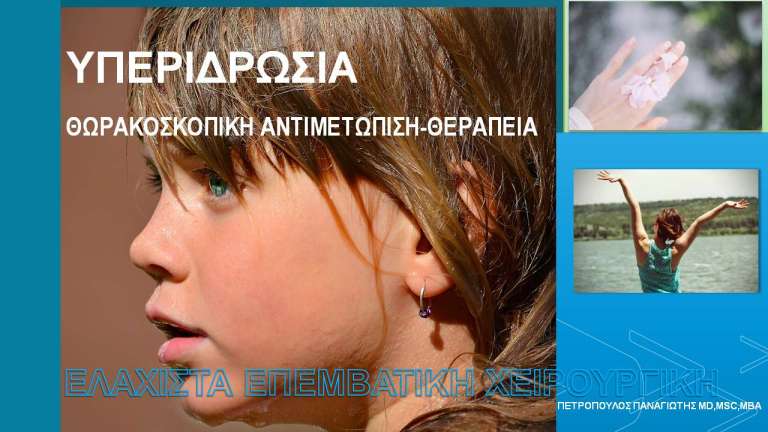 Θωρακοσκοπική Αντιμετώπιση της Υπεριδρωσίας των Χεριών