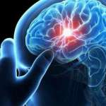Ανεύρυσμα Εγκεφάλου - Πώς να το Εντοπίσετε;