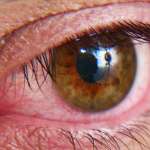 Αλλεργική Επιπεφυκίτιδα και Αίσθημα Καύσου στα Μάτια
