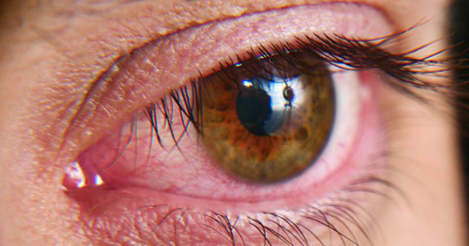 Αλλεργική Επιπεφυκίτιδα και Αίσθημα Καύσου στα Μάτια