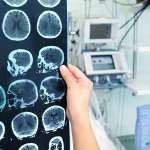 Όγκος Εγκεφάλου - Οι Ελάχιστα Γνωστές Αιτίες