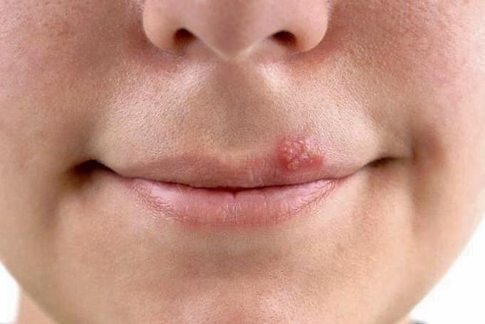 Ο έρπης συχνά ξεκινάει με μυρμήγκιασμα, φαγούρα ή αίσθημα καύσου γύρω από το στόμα σας.