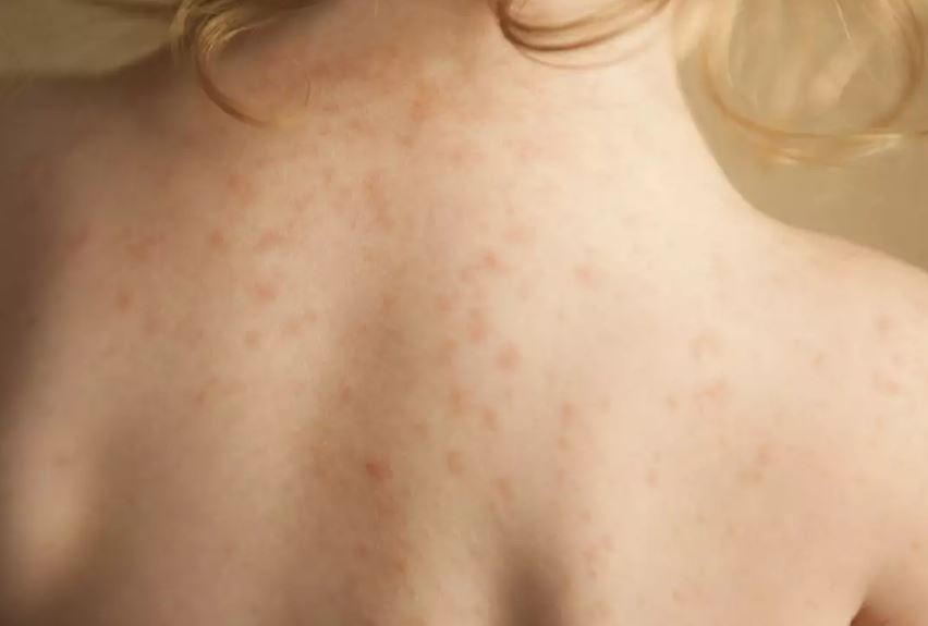 Ο ερεθισμός του δέρματος μπορεί να συνοδεύεται από μια σειρά από συμπτώματα όπως φαγούρα, ερυθρότητα, πρήξιμο και ξεφλούδισμα του δέρματος.