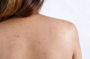 Tips για να μην Εμφανιστεί Ακμή στην Πλατή