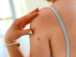 ακμή στο σώμα