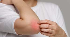 Ατοπική Δερματίτιδα και Θεραπείες