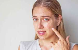 Ακμή των Ενηλίκων και Αιτίες