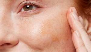 Κνησμός, Ξηροδερμία και Σημάδια Αλλεργίας