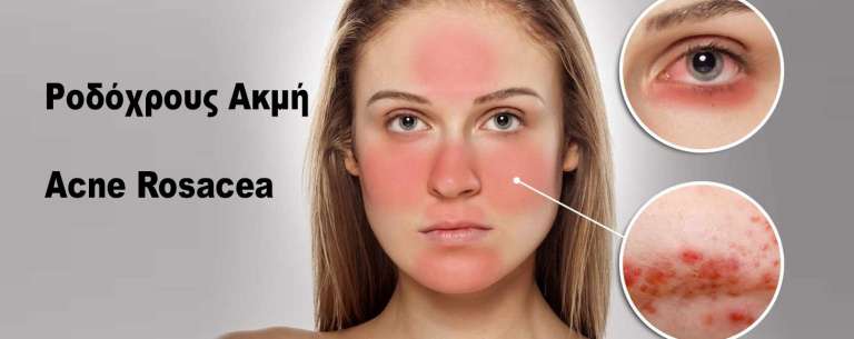 Ήλιος και Ροδόχρους Ακμή: Όλα Όσα θα Πρέπει να Γνωρίζετε