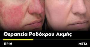 Το άγχος και ο ήλιος είναι παράγοντες που ίσως ευνοούντην εμφάνιση ροδόχρου ακμής μιας κοινής δερματικής ασθένειας που εκδηλώνεται περισσόπτερο σε γυναίκες