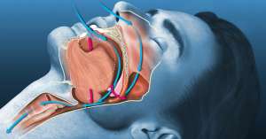 Μείωση θανάτων και καρδιαγγειακών νοσημάτων από υπνική άπνοια με τη συσκευή CPAP που παρέχει θετική πίεση στους πνεύμονες κρατώντας ανοιχτούς τους αεραγωγούς