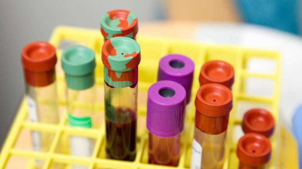 Εγκεφαλικό: Η ομάδα αίματος αποκαλύπτει αν κινδυνεύετε